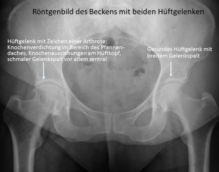 Arthrose des Hüftgelenkes Orthopaedicus Leipzig Arthrose des Hüftgelenkes Orthopaedicus Leipzig